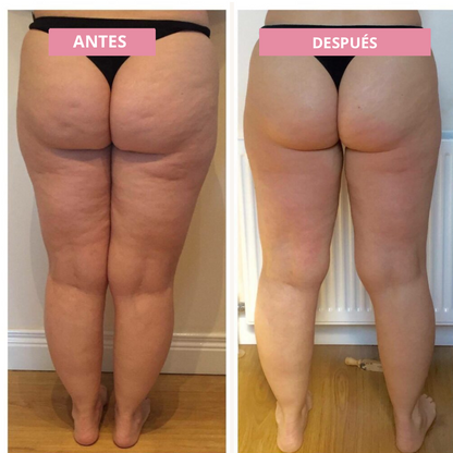 Nayras™ Dispositivo Anticelulitis